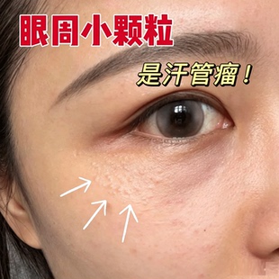 汗管瘤眼部去除神器搭专用膏药贴去眼周消除小疙瘩脂肪粒扁平疣YU