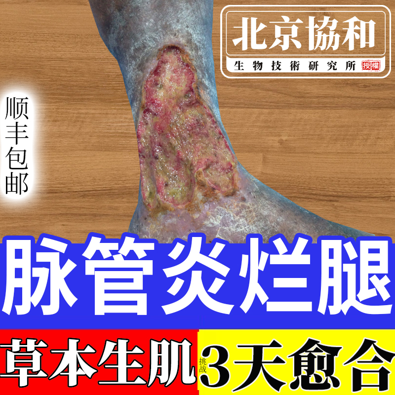 【北京协和】脉管炎烂腿生肌膏