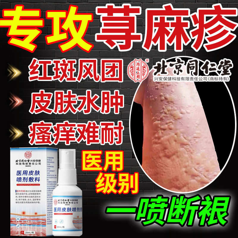 急慢性寻荨麻疹过敏止痒断的专用特效根风团红肿治疗提高免疫力Y