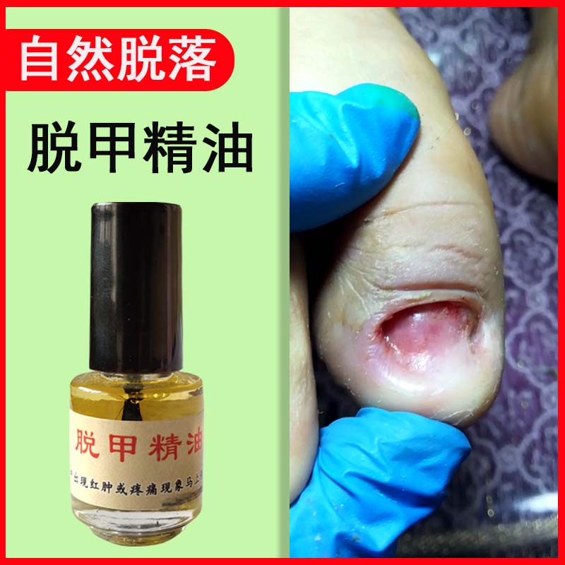 灰甲精油快速软甲液祛甲无痛祛坏美甲工具