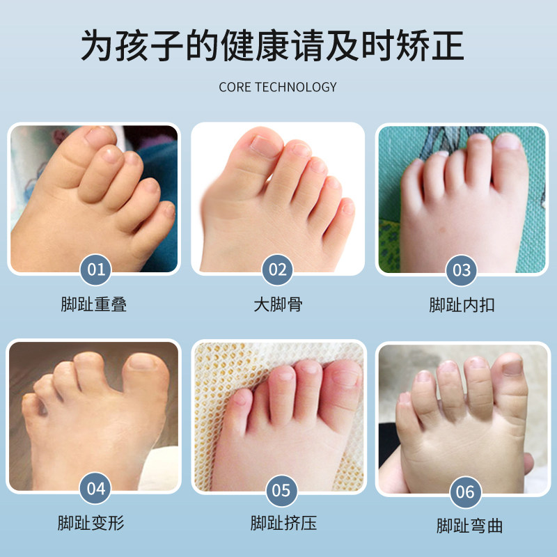 儿童脚趾重叠内扣变形分离矫正器婴幼儿1-6岁宝宝专用脚趾矫正器