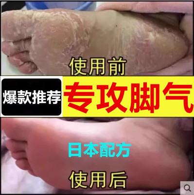 去脚气止痒脱皮杀菌真菌感染专用
