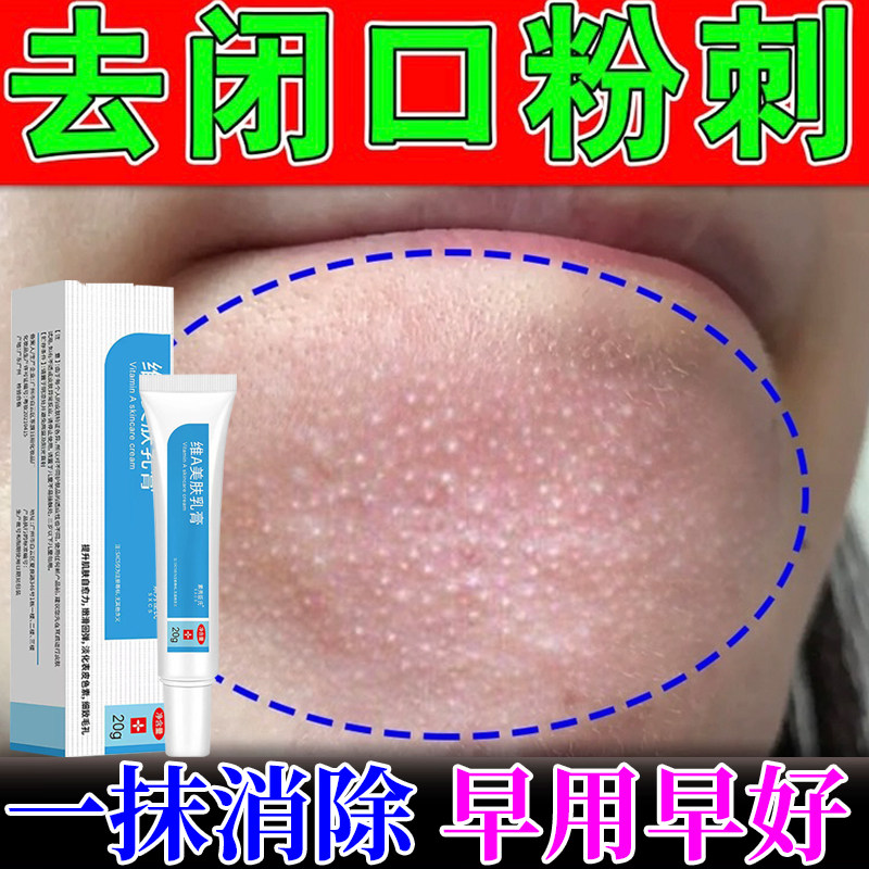 闭口粉刺的克星脸上起小疙瘩去除脸部逆光疹闭合脂肪额头痘小颗粒
