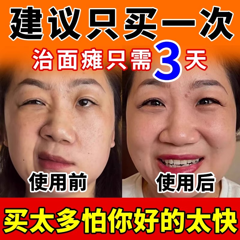 面瘫贴熬夜面瘫脸部变形专用神器
