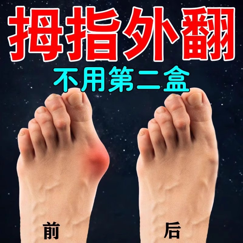 【一夜裉治】拇指外翻贴重症大脚骨外翻脚趾重叠防磨拇指外翻膏贴