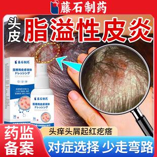脂溢性皮炎头部喷雾剂头皮屑止痒真菌感染头癣头痒有疙瘩起痤疮WQ