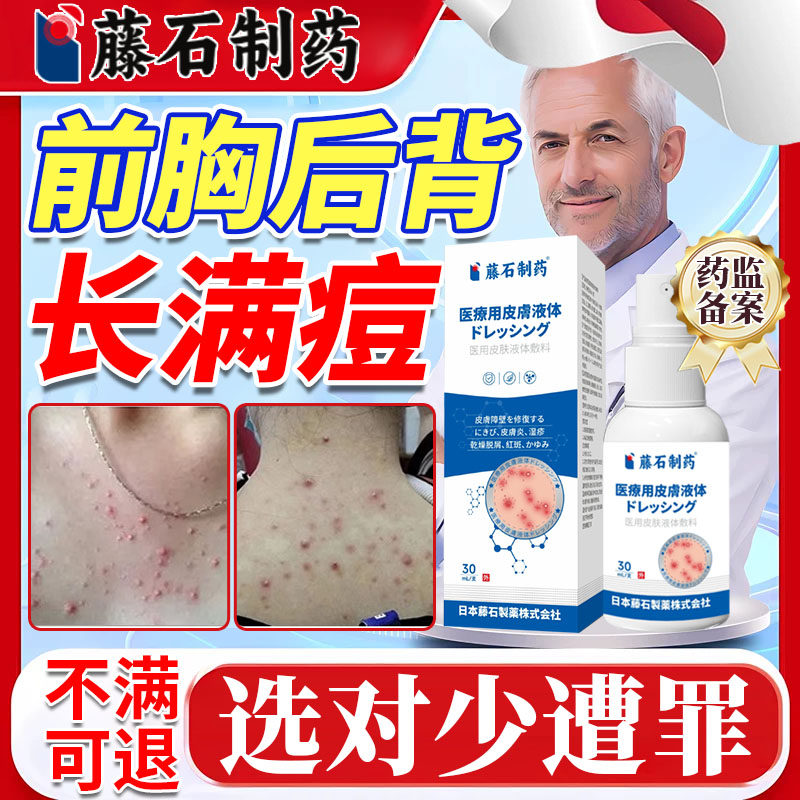 前胸后背上长痘毛囊炎除螨