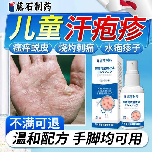 儿童脚手上起小水泡汗疹汉
