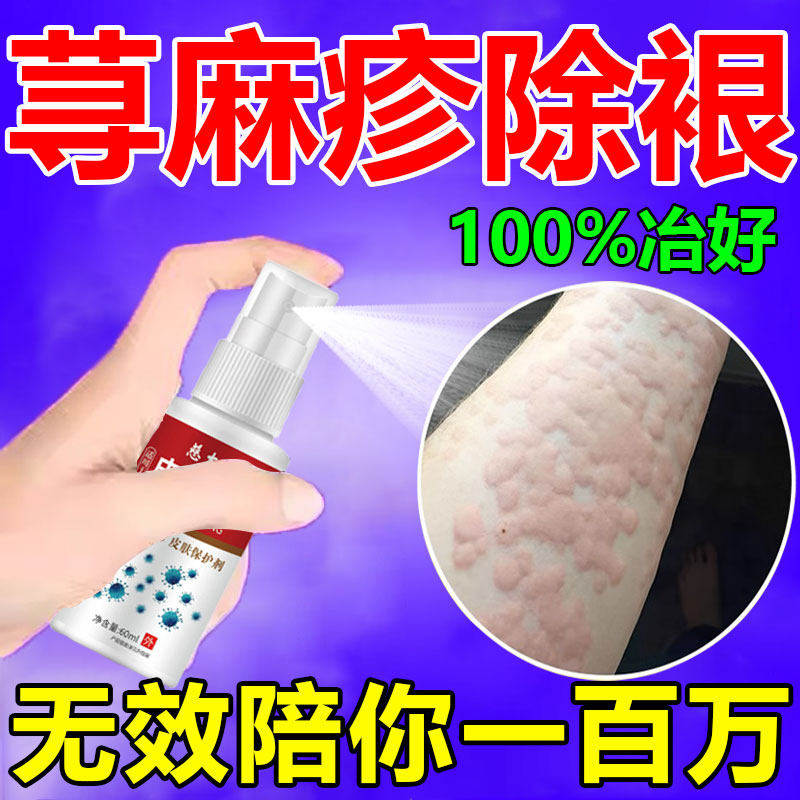 【反复荨麻疹】寻荨麻疹过敏止痒断提高免疫力中药荨麻消茶根喷剂