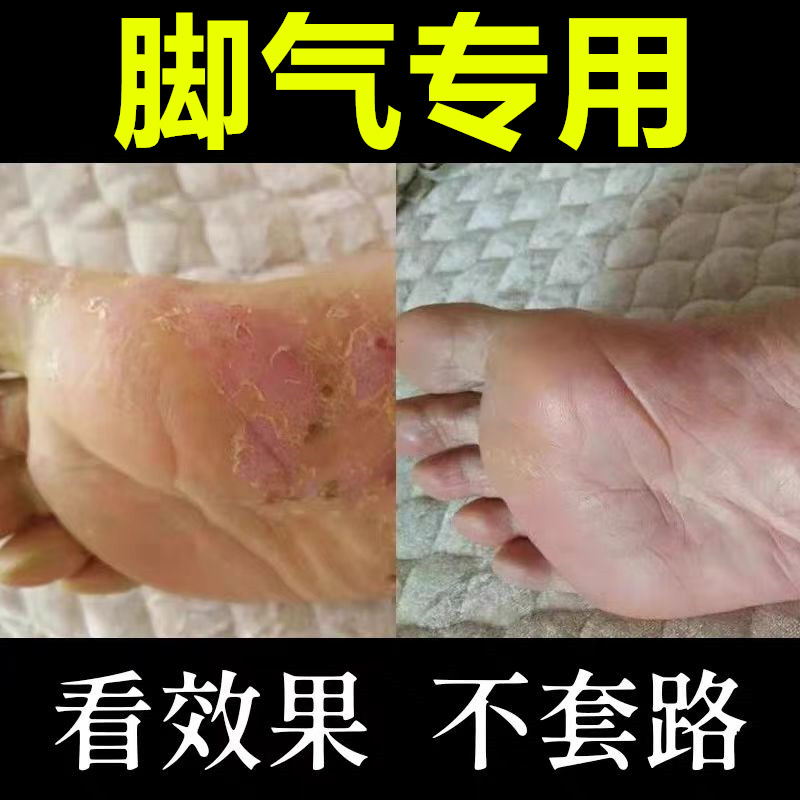 去脚气根专用特效止痒脱皮杀菌喷剂烂脚丫药脱皮糜烂脚趾脚臭出汗