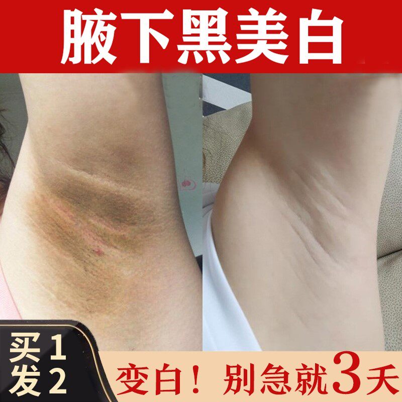 腋下黑腋窝黑色素腋咯吱窝关节黑脖子棘皮沉淀