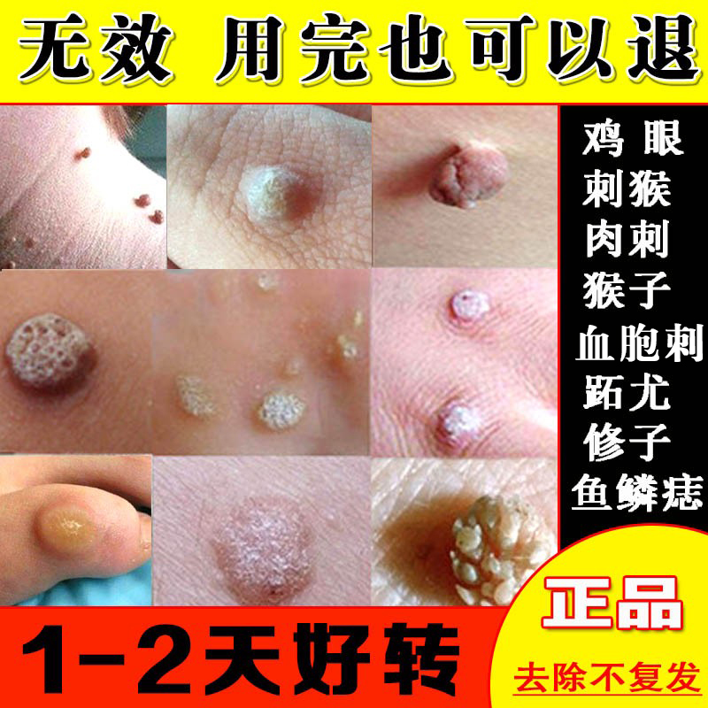 鱼鳞痣肉刺去除膏手足