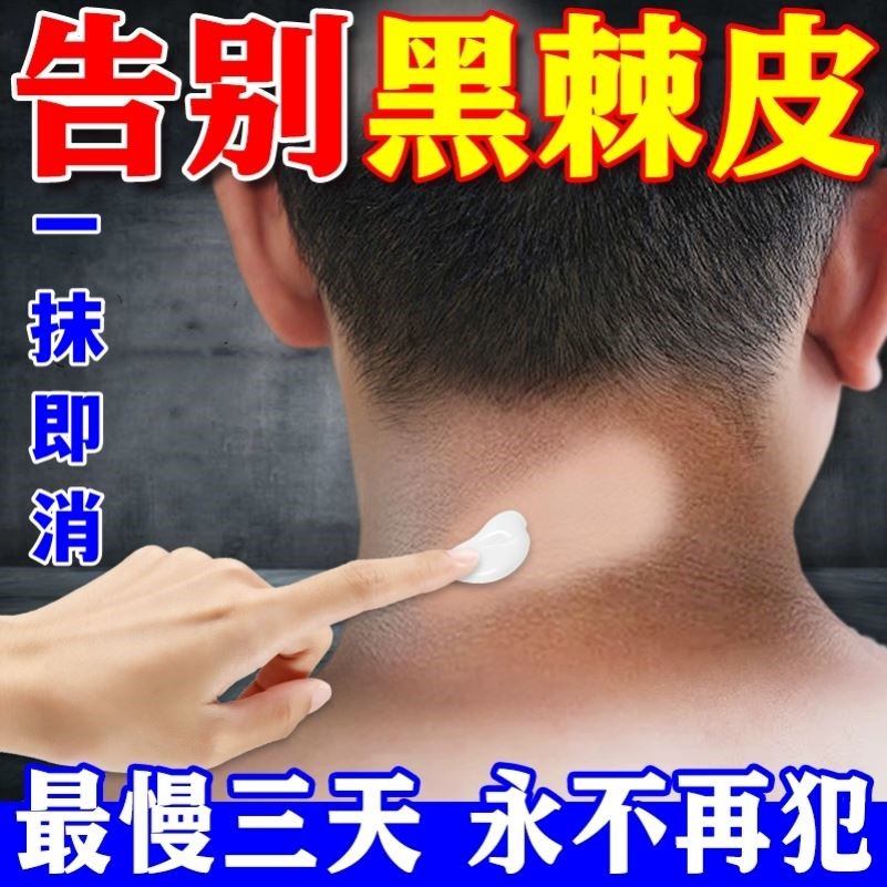 脖子黑黑的黑棘皮症去除脖子黑色素沉淀洗不干净肥胖儿童神器