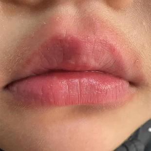 口周唇炎润唇膏嘴唇圈红嘴唇干裂脱皮修复药用润唇膏修护唇炎专用