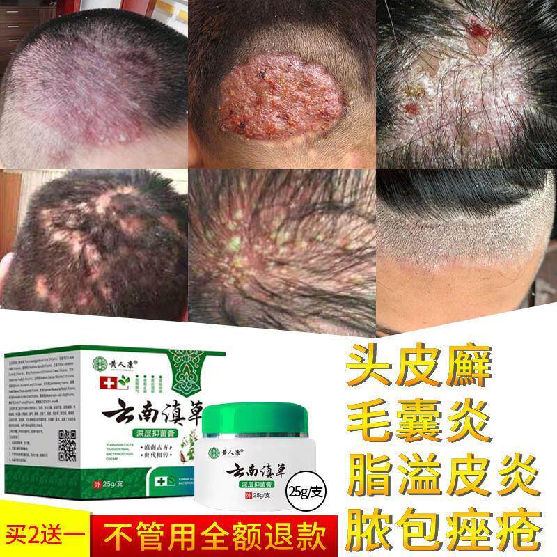 毛囊炎软膏头皮部脸头部私处后背头上长痘痘痒有疙瘩专用乳膏