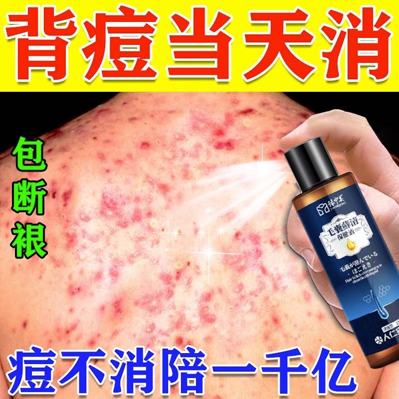 背后痘痘去除背上长痘痘后背除螨虫黑头粉刺抑菌净痘止痒杀菌神器