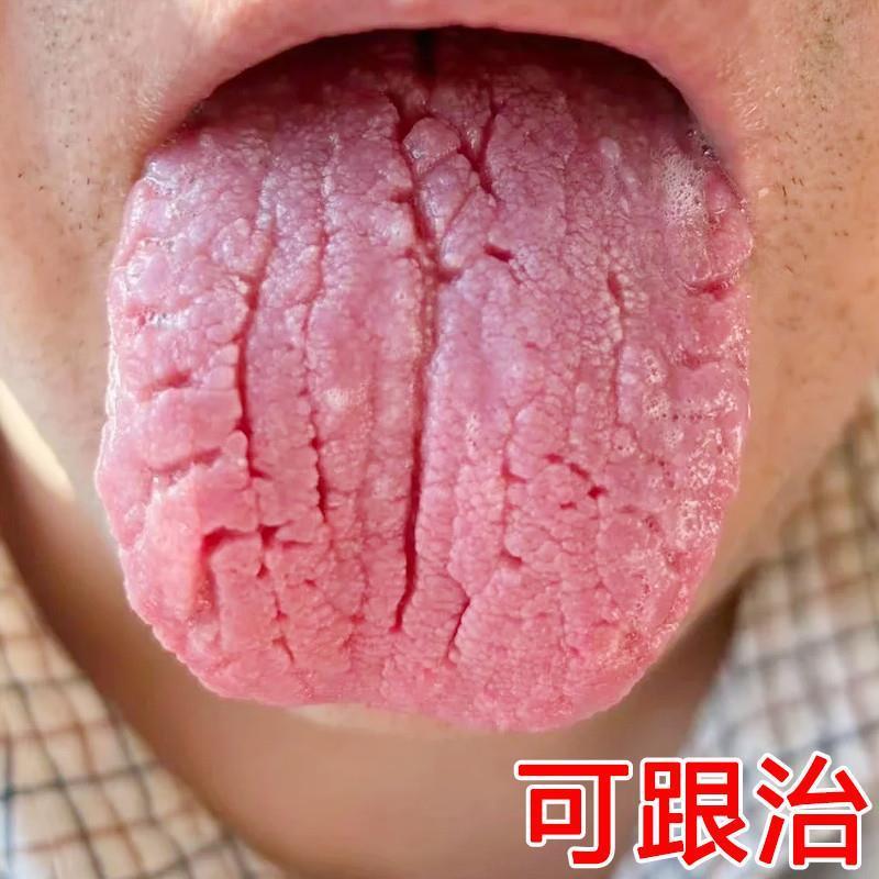 舌头裂痕裂纹舌地图舌齿痕灼口综合症舌头发白发厚湿气舌头疼喷剂