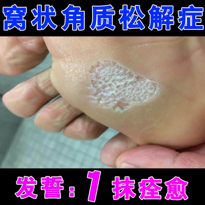 药脚底板发白起泡窝状角质松解症蜂窝状沙虫脚烂脚脚臭脚痒出汗膏