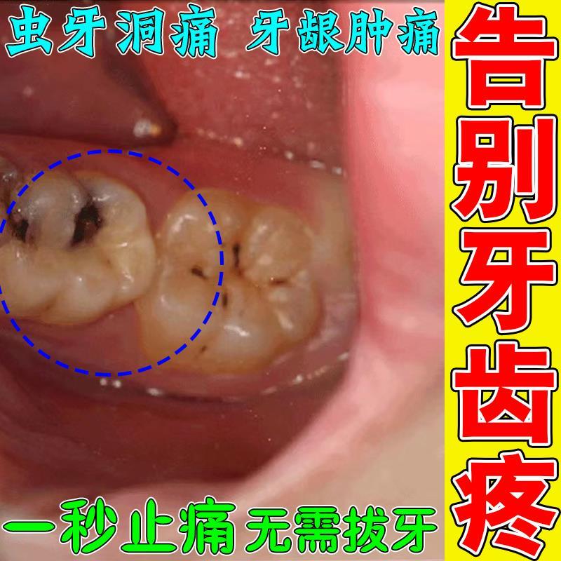 治疗长期牙痛牙疼止疼剂速效喷雾口鼻清洁杀菌消炎剂