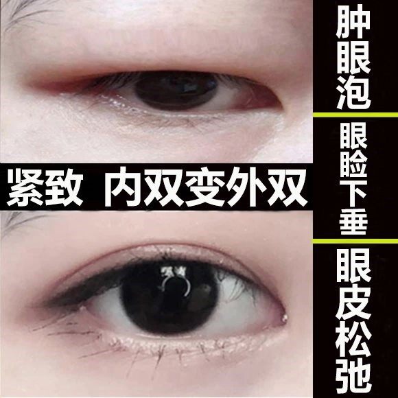 上眼皮松弛下垂提拉紧致贴眼睑消浮肿去脂肪肿眼泡去肿内双变外双
