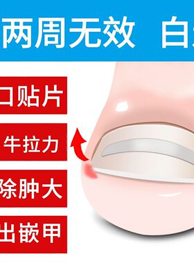 小型指夹家用拉伸脚指脚趾甲脚沟炎矫正器校正立正大拇指甲正嵌甲
