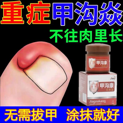 甲沟炎治疗专用药甲沟炎特效药膏嵌甲克星