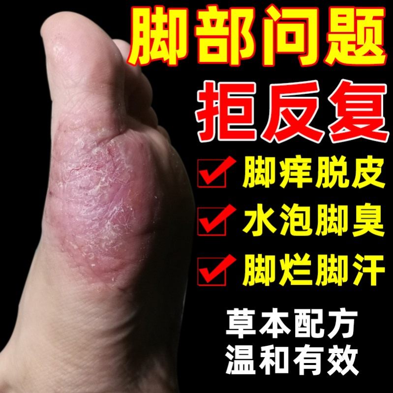 擦脚药膏百草止痒膏湿疹止痒去根专用水泡型脚气专用脚底脱皮药膏