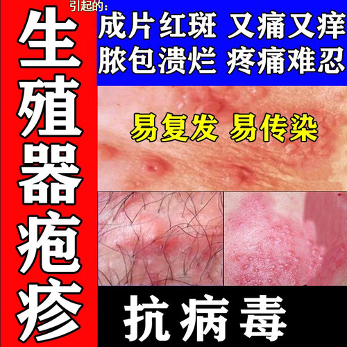 【亚邦】阿昔洛韦乳膏3%*10g*1支/盒