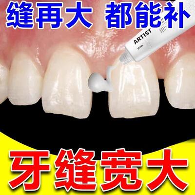 牙缝宽大修复神器补牙缝牙膏填充门牙牙缝大矫正防堵蛀牙牙洞清理