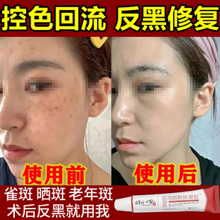 脸上激光祛斑后反黑修复产品黑斑去除分解黑色素沉淀疤痕去黑印TT