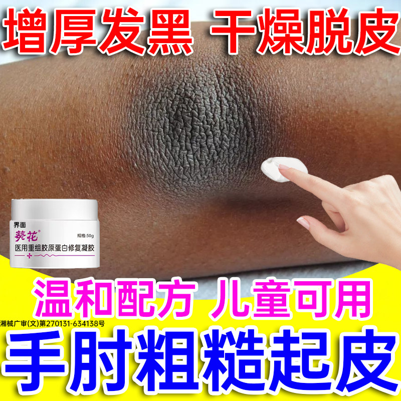 胳膊肘去黑皮肤色素沉淀去除干燥起皮手肘关节神器去除皮炎癣藓PP