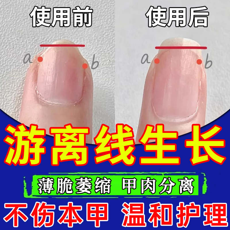 手指甲游离线生长液儿童空甲养甲肉分离修复液萎缩受损再生增长TT