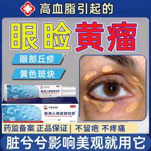 眼睑黄色瘤黄瘤睑黄疣眼角黄斑瘤眼部脂肪粒药监备案膏去除祛MR