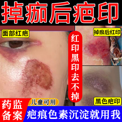 【三甲同款】疤痕色沉修复膏