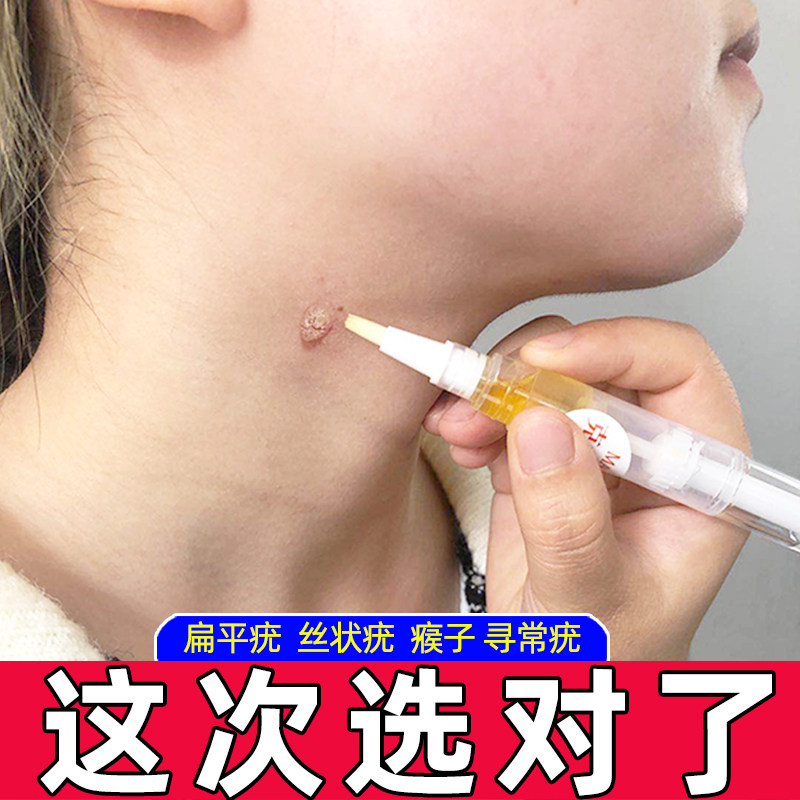 扁平疣药正品面部日本去疣灵肉刺瘊子去除膏趾疣跖疣膏足部疣瘊净