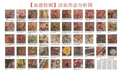 血液检测图说明活形态分析墙贴画