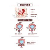 盆底肌恢复过程示意图知常识宣传墙贴纸写真挂图海报印制