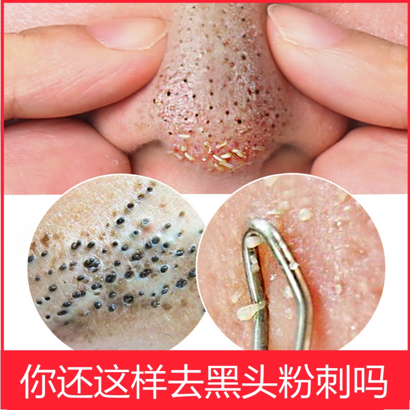 小气泡清洁面膜去黑头粉刺闭口深层清洁泥膜收缩毛孔堵塞疏通毛囊