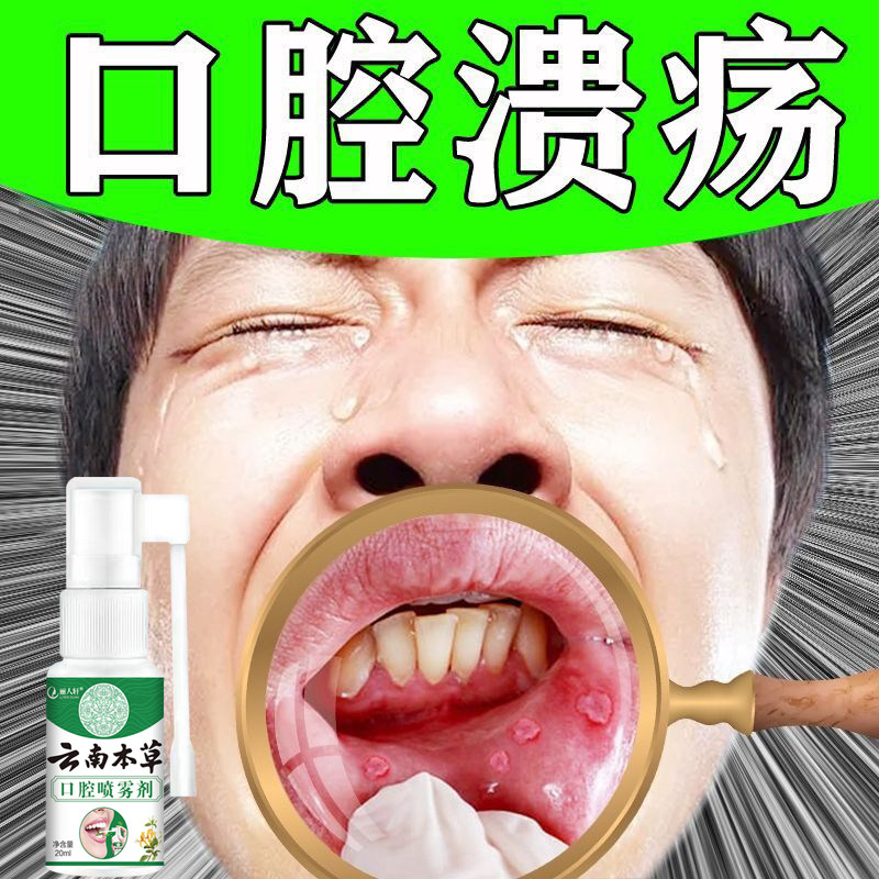 口腔溃疡专用喷雾喷剂神凝胶舌头上火起泡修复液非薬儿童成人口喷