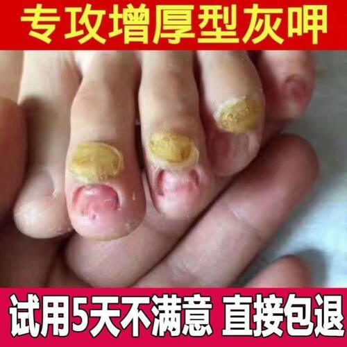 圣巴洛芭洛康笔比康生灵灰指甲李四灰甲珍丫可软涵函甲康宁正品