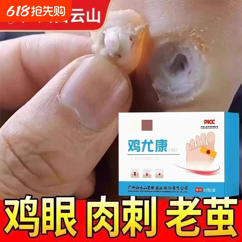 鸡眼贴去鸡眼神器老茧脚底钉祛除跖疣足部鸡贴眼膏正品官方旗舰店