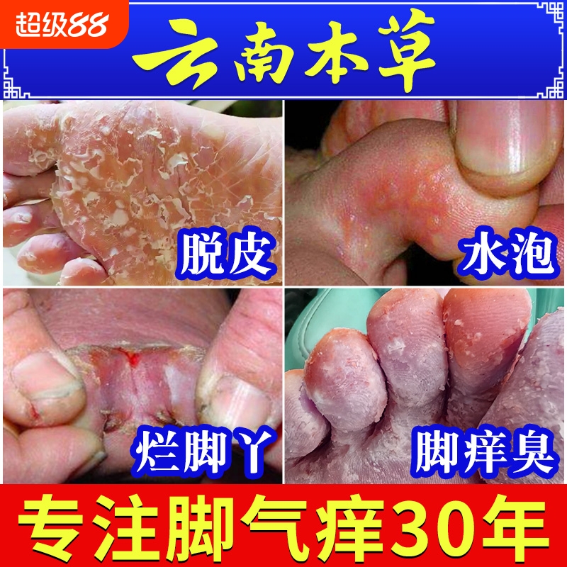 【官方正品】云南本草脚臭脚汗喷雾剂止汗防脚臭鞋袜除臭喷剂