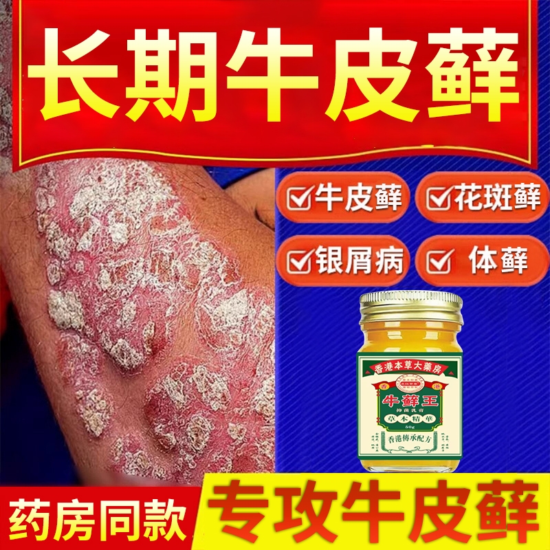 香港牛藓王牛皮痒癣头皮股银去屑病专用膏正品皮肤杀菌止痒抑菌