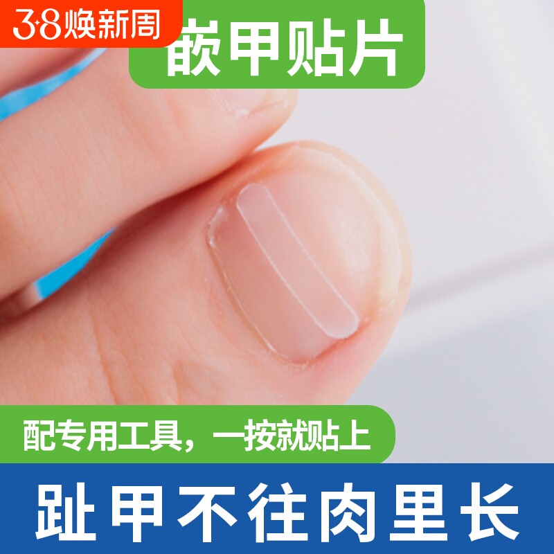 正甲贴夹沟脚指甲长肉里正甲贴片甲沟嵌甲趾甲神器炎非矫正器