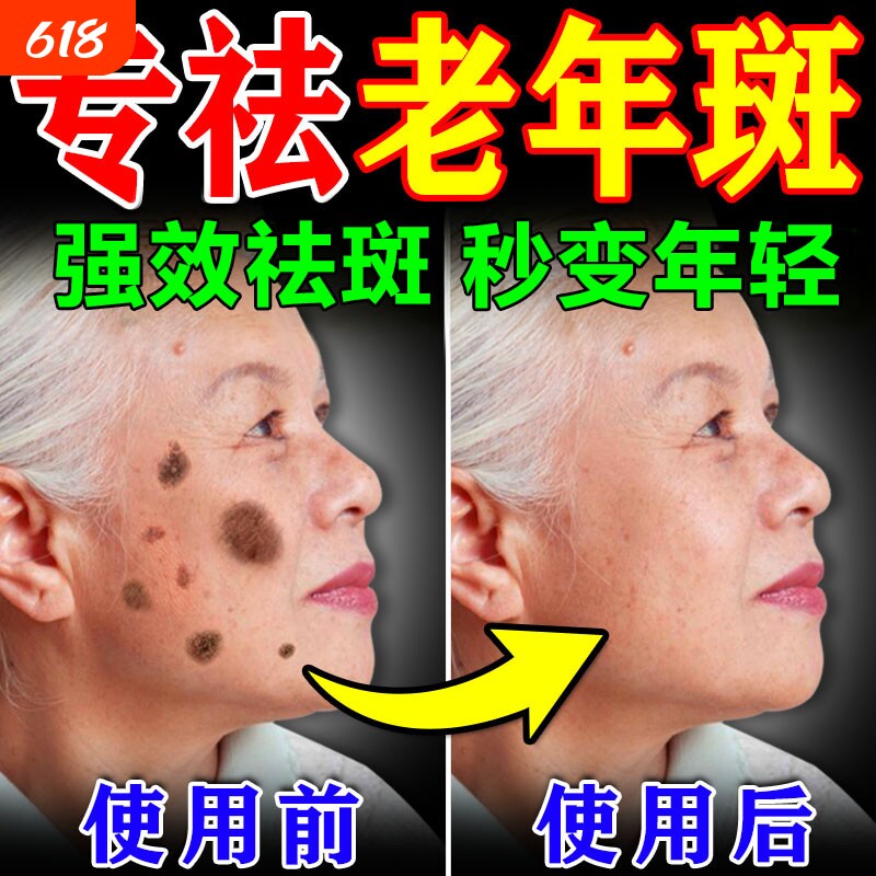 老年斑美白祛斑霜黄褐专用膏药强力去手部除脸部一擦就掉中老年人