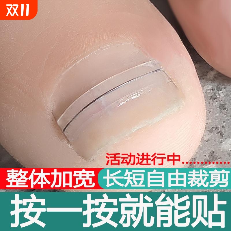 甲沟炎矫正器正甲贴片镍钛合金仿生骨贴脚趾甲指甲扎肉矫正器工具