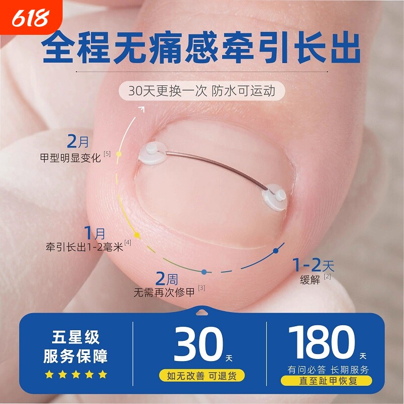 嵌甲正甲贴甲沟疼合金矫正钢丝记忆弹力贴胶水套装脚指甲趾甲金属