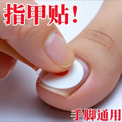 【香港断货王】灰趾增厚正品专用灰指贴发黄粉碎甲脚趾手指甲专用