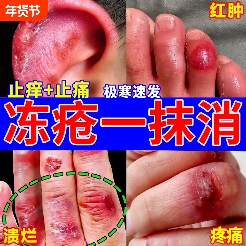 冻疮膏止痒冻伤膏干裂防冻裂专用儿童耳朵脸部手足防冻防裂护手Z
