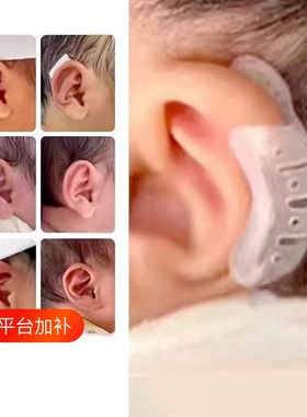 耳朵矫正器婴辅助定型器材